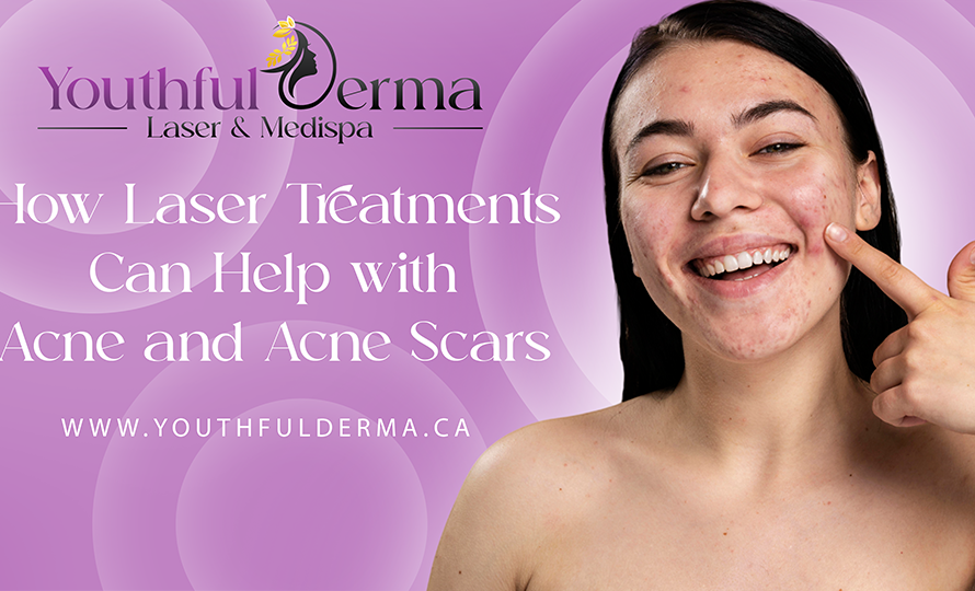 How Laser Treatments Can Help with Acne and Acne Scars