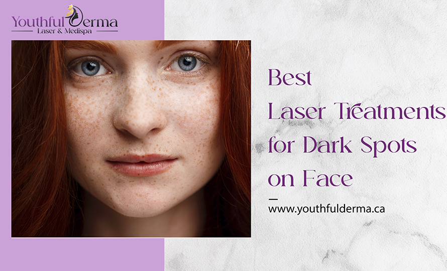 Best Laser Treatments for Dark Spots on Face