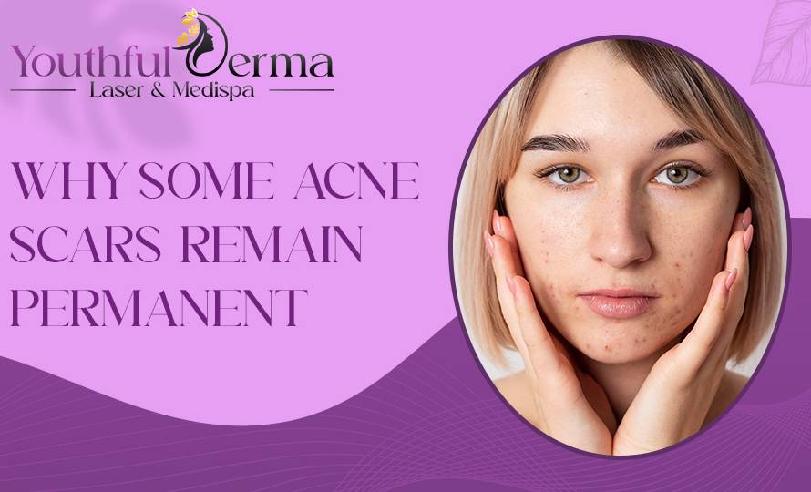 Why Some Acne Scars Remain Permanent