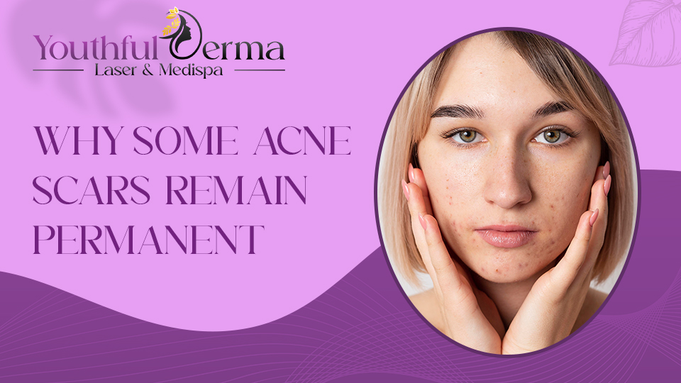 Why Some Acne Scars Remain Permanent 1 Why Some Acne Scars Remain Permanent