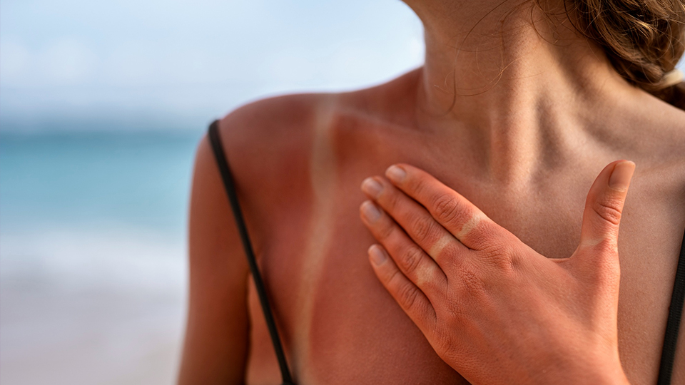 Best Facial Treatments for Sun-Damaged Skin 5 sunburn