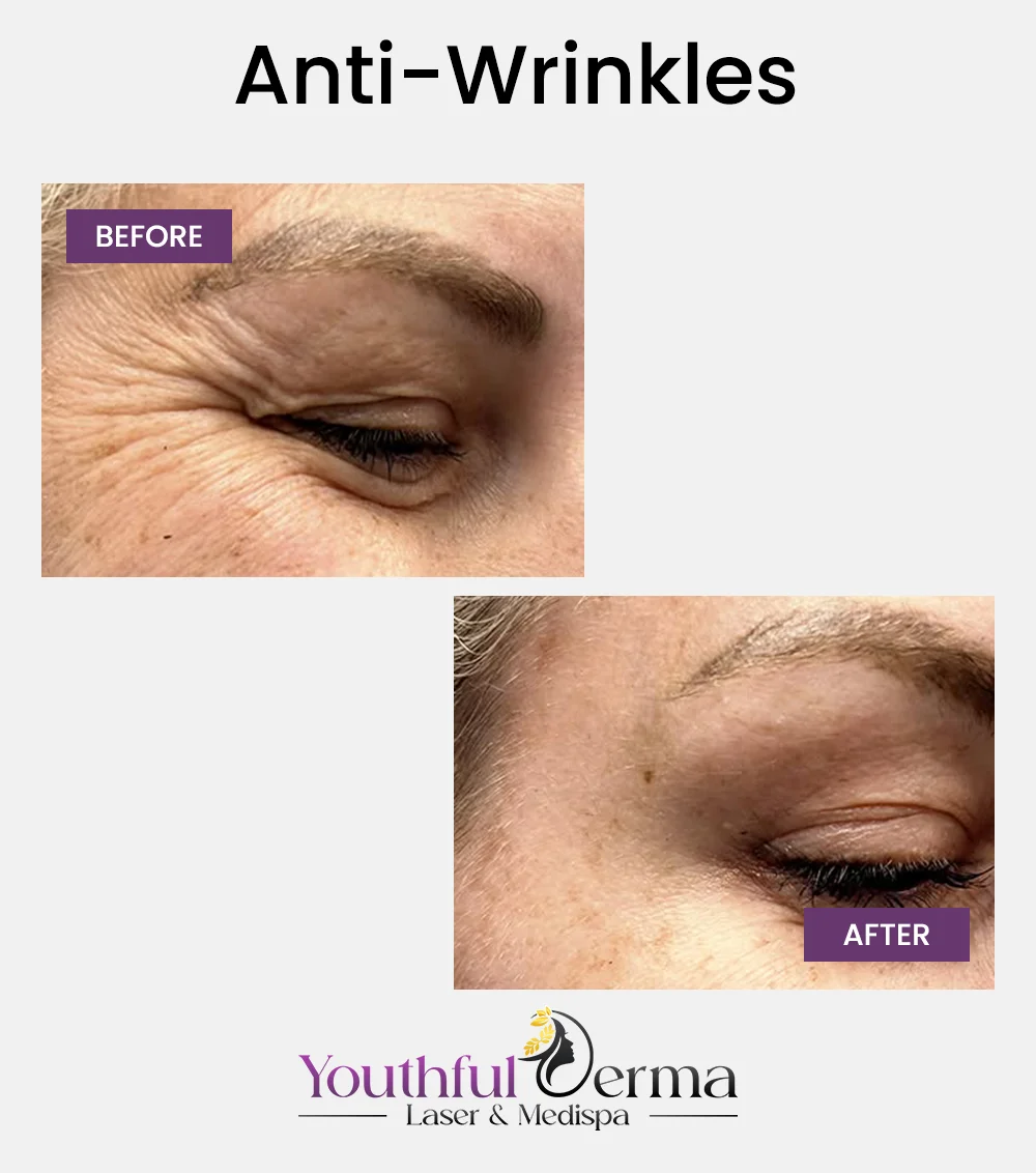 anti-wrinkles-before-&-after-1