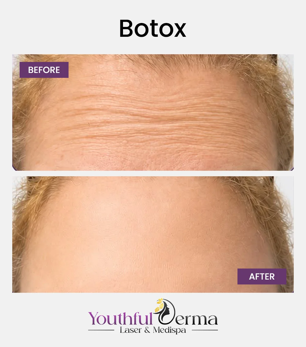 botox-before-&-after-1