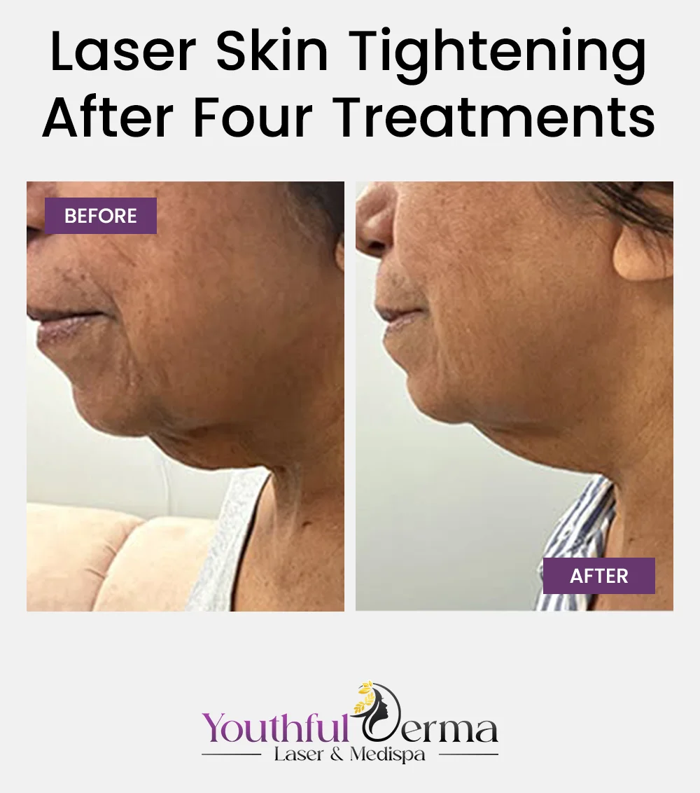 laser-skin-tightening-before-&-after-1