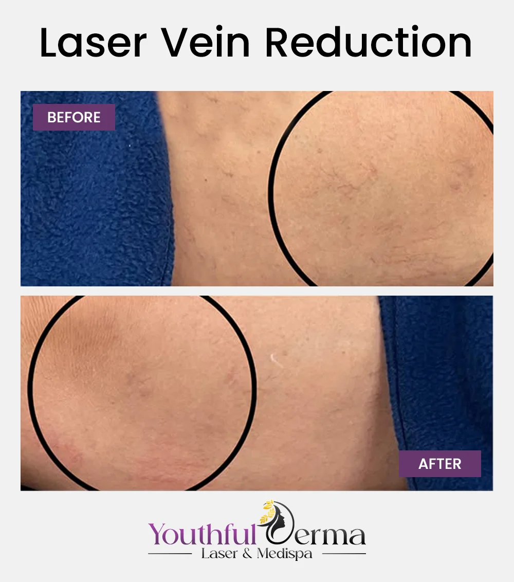 laser-vein-reduction-before-&-after-1