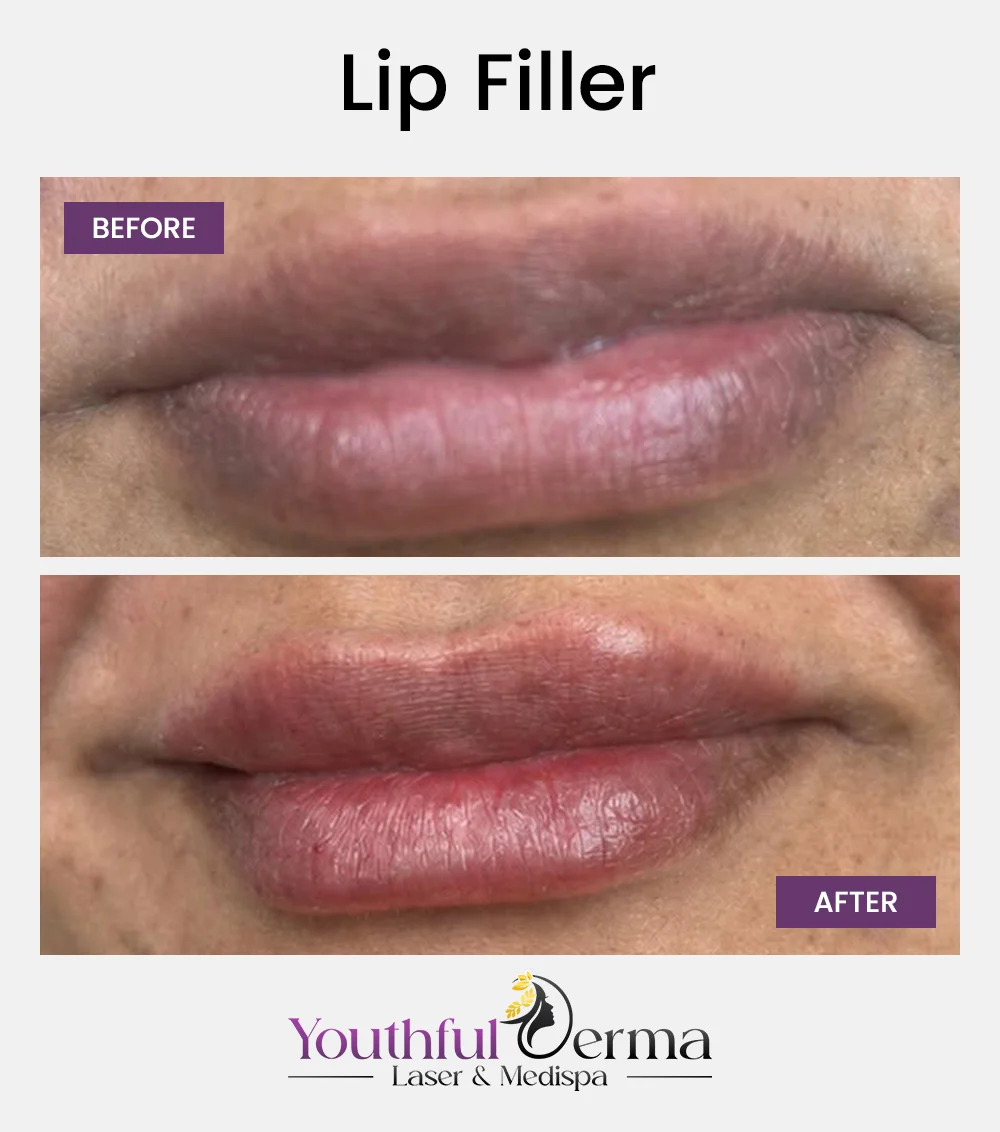 lip-filler-reuslt-1