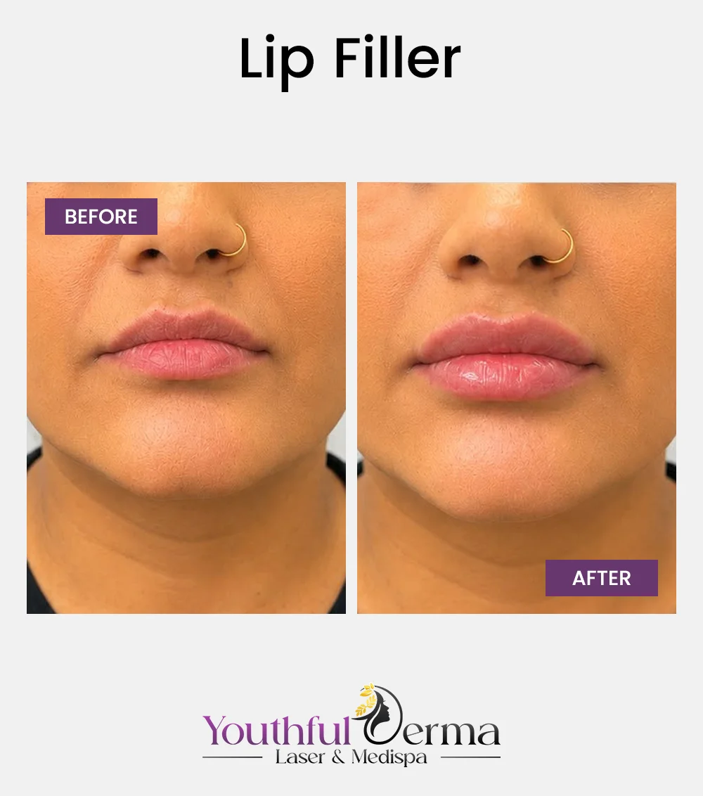 lip-filler-reuslt-10