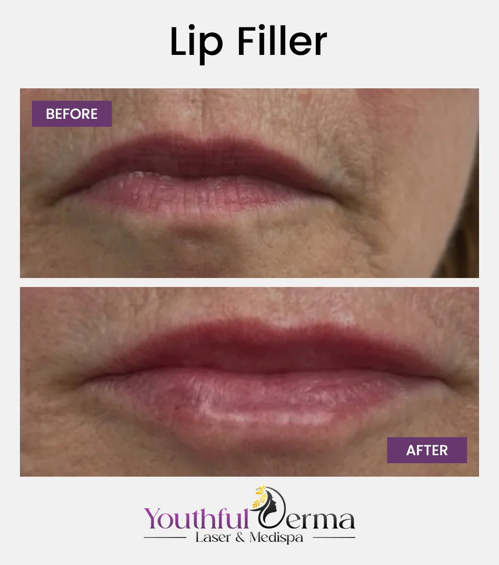 lip-filler-reuslt-3