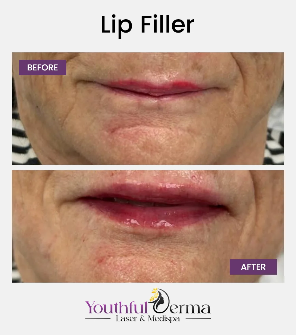 lip-filler-reuslt-4
