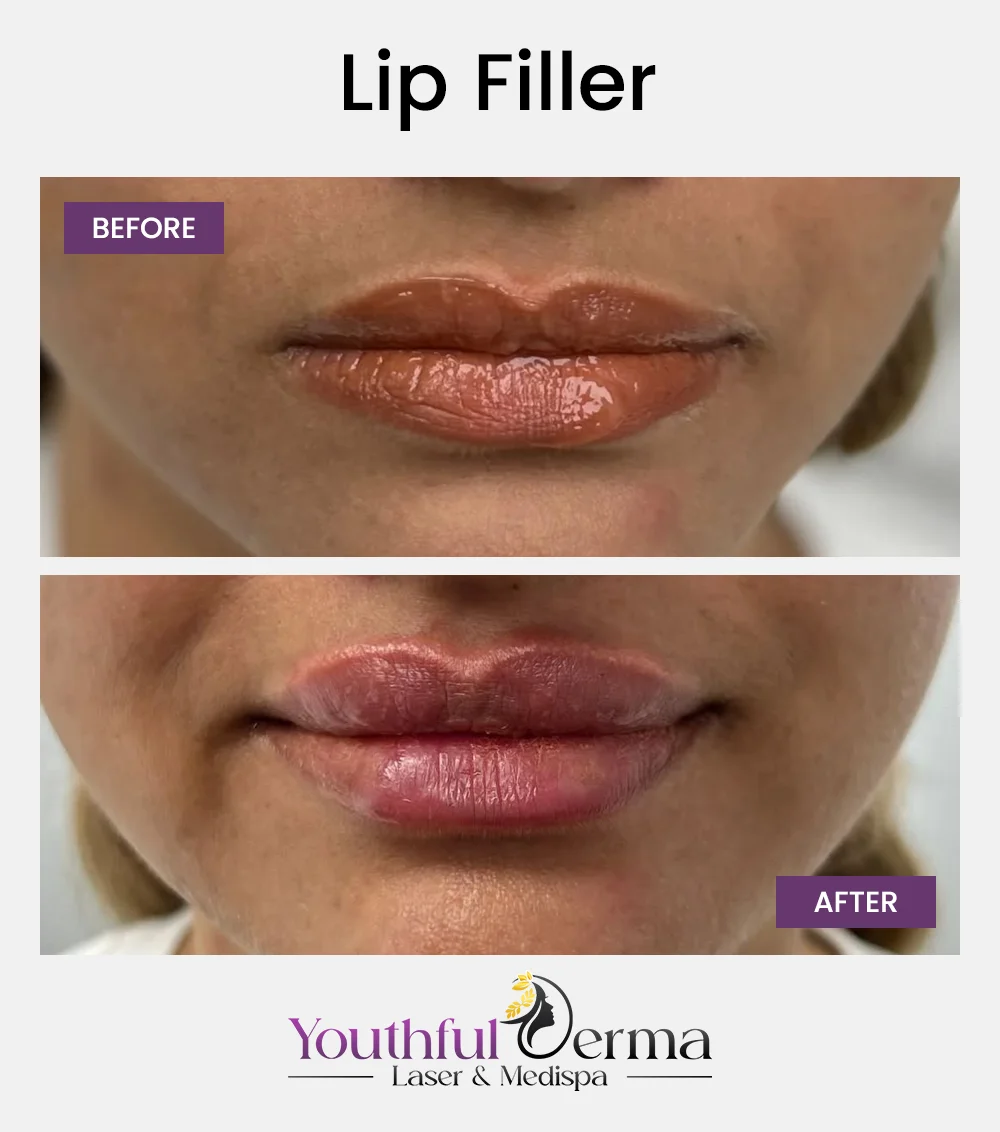 lip-filler-reuslt-5