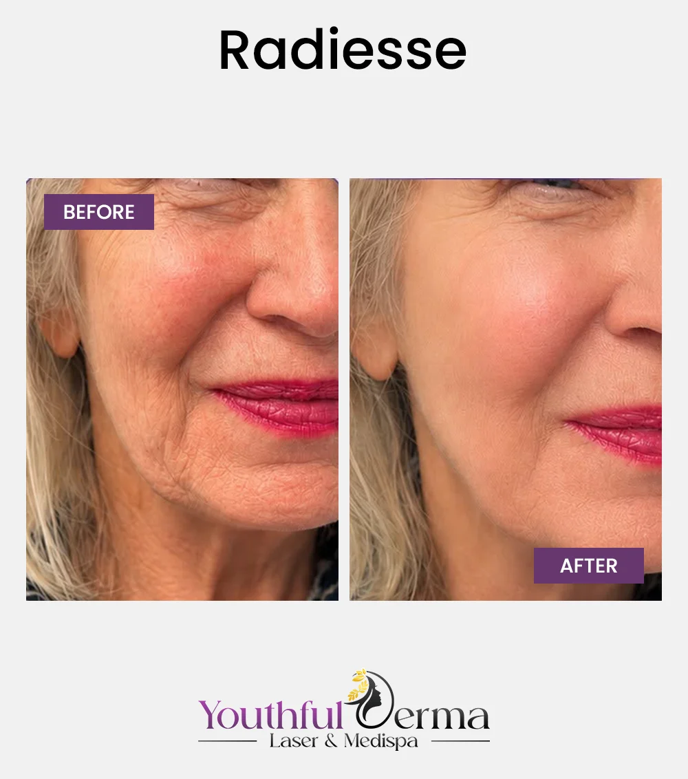 radiesse-before-&-after-1