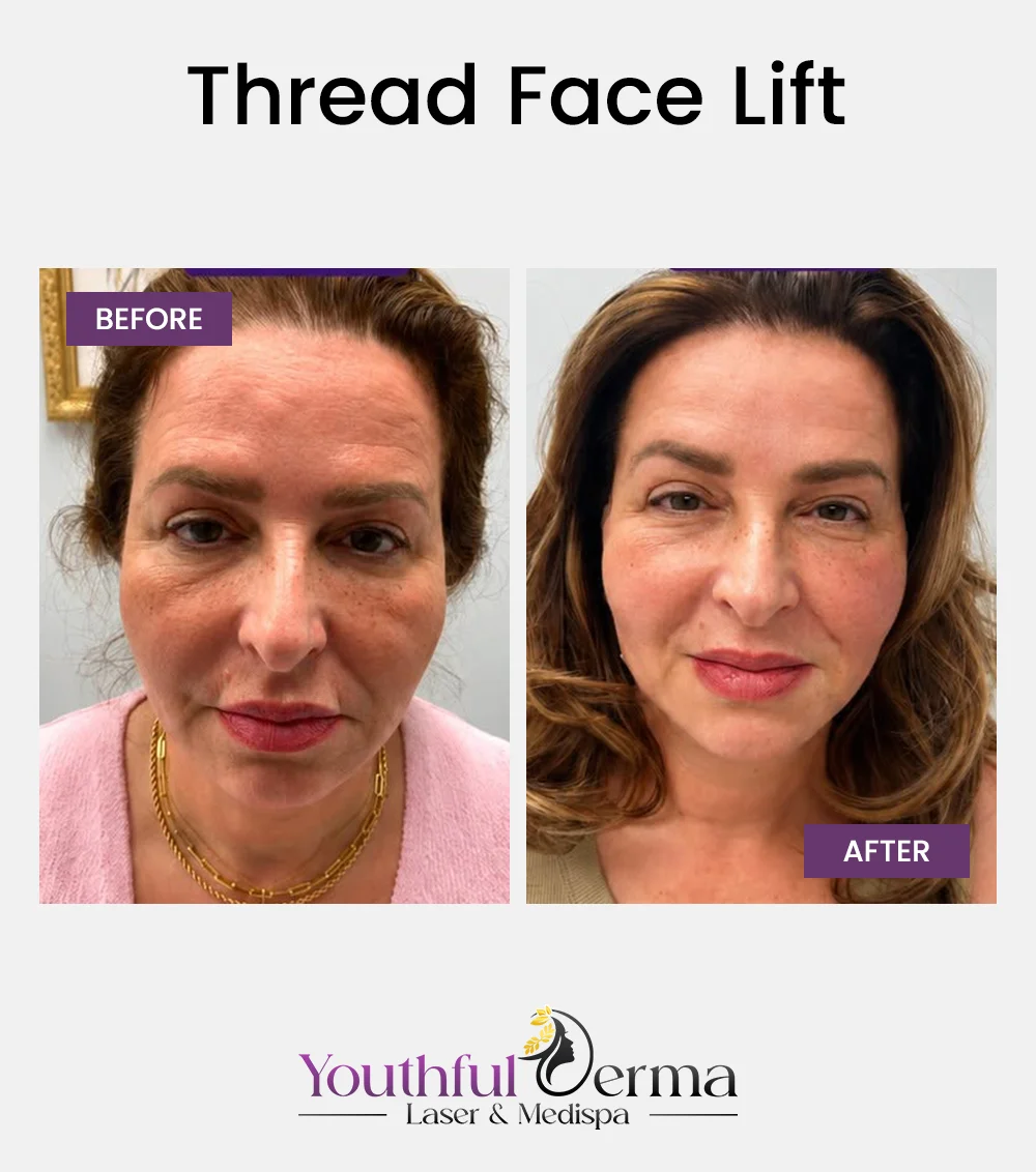 thread-face-lift-before-&-after-1