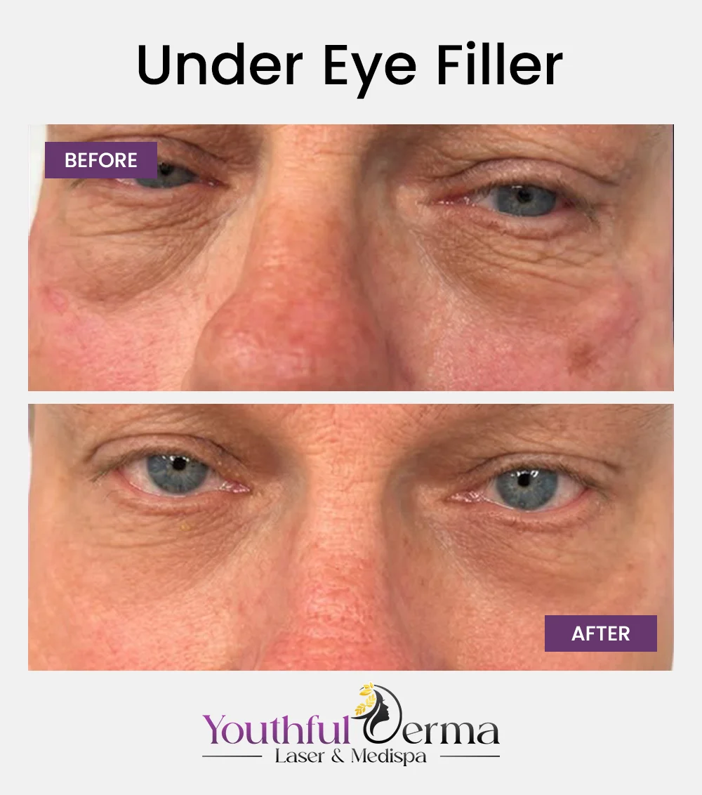 under-eye-filler-before-after-1